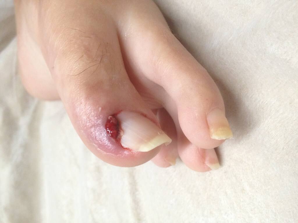 big toe with bulbous red lump beside toenail