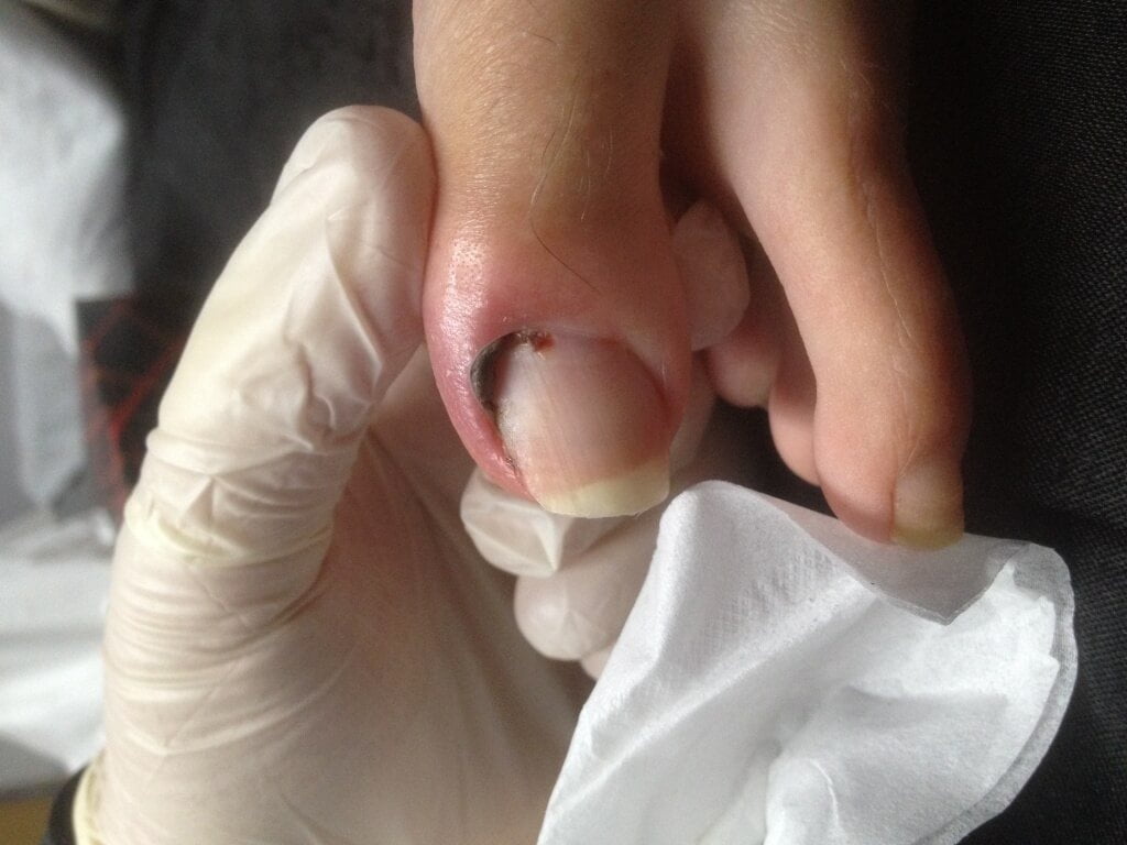 big toe with blackened flesh along side