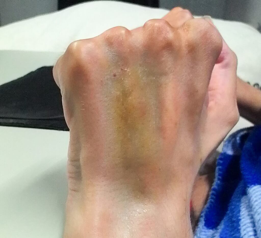the back of a hand with some purple and yellow bruising